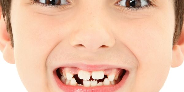 Dentes frouxos, dente incerto - causas em adultos e crianças