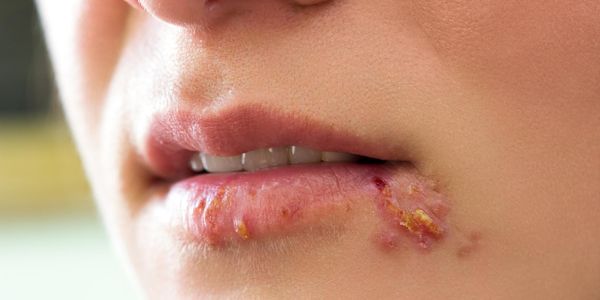 Infecção pelo Vírus do Herpes Simplex (HSV), Tipos, Imagens, Tratamento