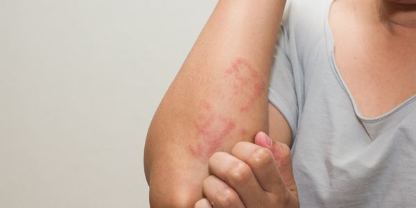 Teste de alergia: maneiras de descobrir se você é alérgico