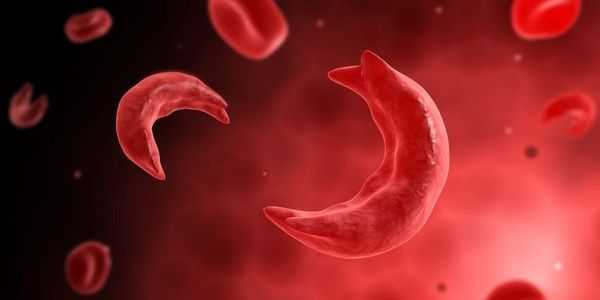 anemia falciforme-sickled-glóbulos vermelhos