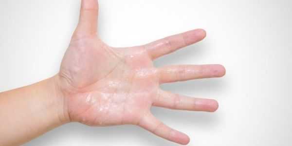 causas-tratamento-de-palmar-hiperidrose-palmas das mãos suadas