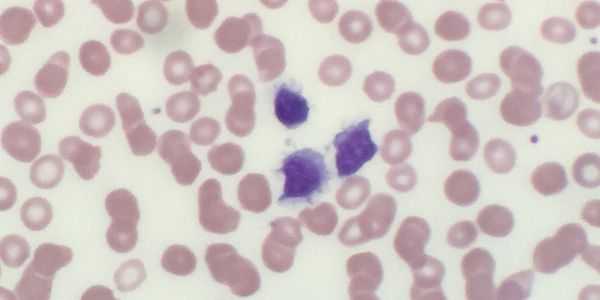 leucemia de células pilosas-hcl