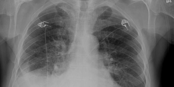 Aspiração Pneumonia – Significado, Causas, Sintomas, Tratamento