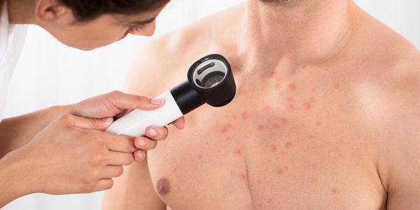 Causas da acne, localização, fotos de espinhas no rosto, no peito e nas costas
