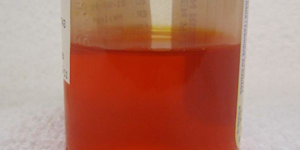 Causas de urina marrom de descoloração castanho-clara, marrom escuro