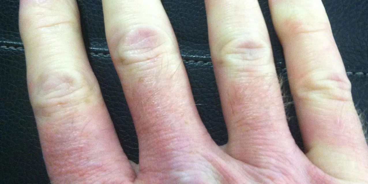 Causas e sintomas de mãos e dedos azuis