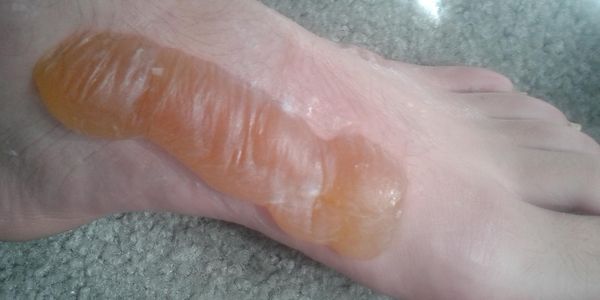 Cinco razões comuns para queimar pés com testes e tratamentos