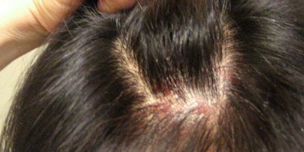 Coceira no couro cabeludo – fotos, causas e tratamento