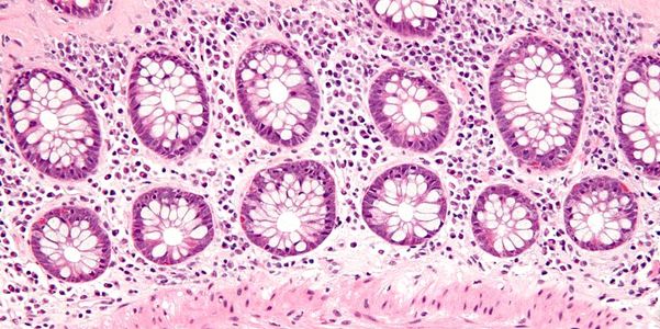 Colite Colagenosa e Linfocítica (Microscópica) – Sintomas, Tratamento