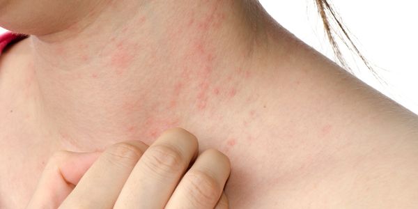 Como aliviar o eczema e viver com ele
