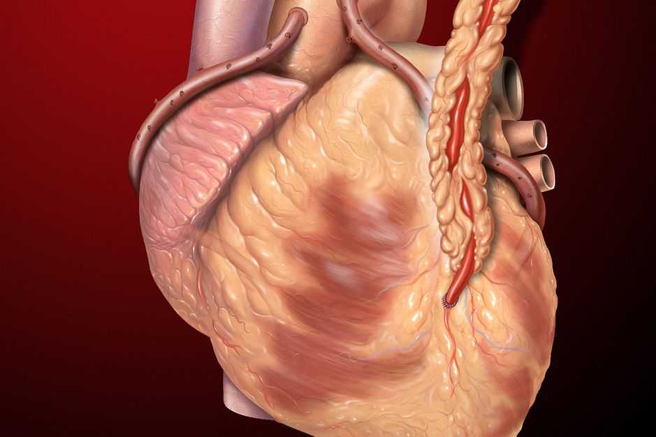 Como identificar a doença arterial coronariana (DAC) sem testes