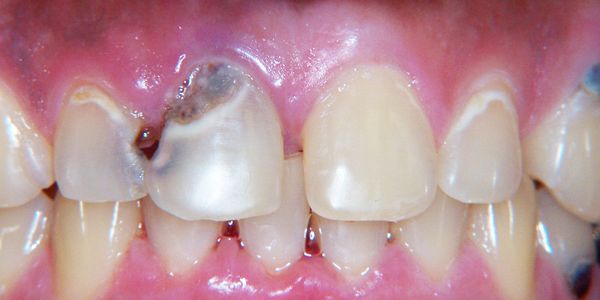 Cárie dentária (dentes cavidades) causa dor de dente e mandíbula