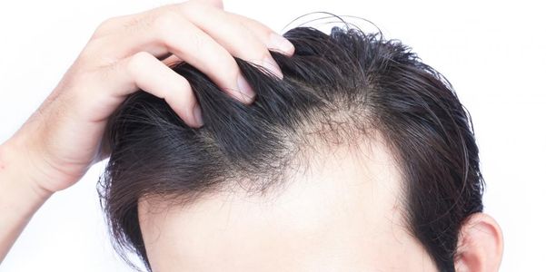 Derramamento de perda de cabelo (eflúvio telógeno) tipos e causas