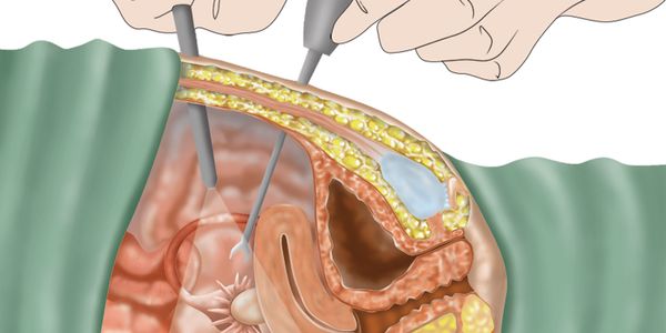 Efeitos colaterais da histerectomia – Procedimento, Complicações de anestesia