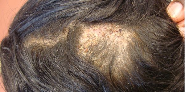 Favus (fungo de cabeça grave) causas, sintomas, tratamento