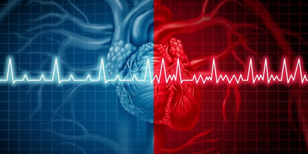 Fibrilação Atrial (Quivering Heart) Causas, Sintomas, Tratamento