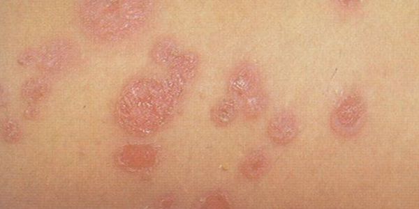 Impetigo Skin Infection Causas, Imagens, Tratamento