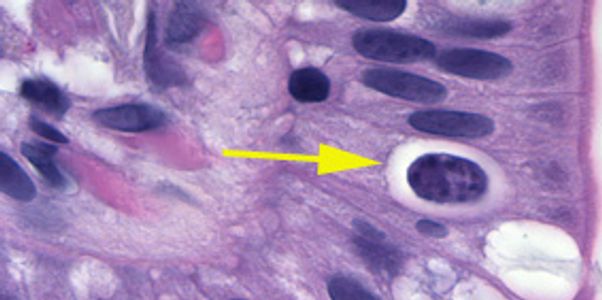 Isosporíase (Infecção por Isospora belli)