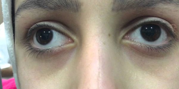 Nistagmo (movimentos anormais dos olhos) Tipos, Vídeo, Causas