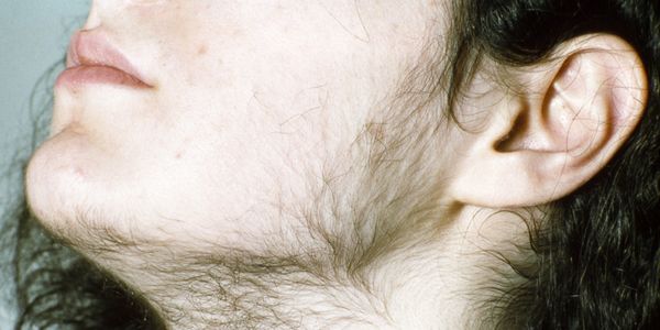 O que é hipertricose Crescimento excessivo de pêlos corporais