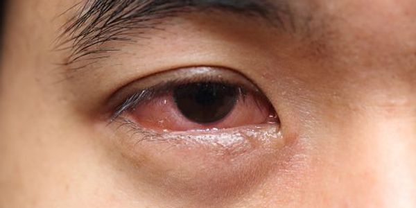 Olho Muco (Excessivo e Crusty) – Causas e Sintomas