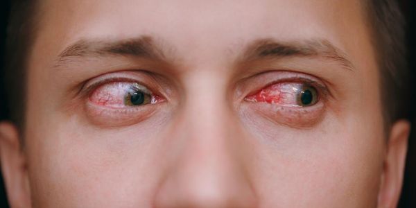 Olho vermelho crônico da lente de contato, infecção dos “olhos cor-de-rosa”