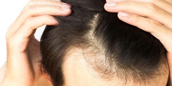 Perda de cabelo do couro cabeludo – causas de calvície em homens e mulheres