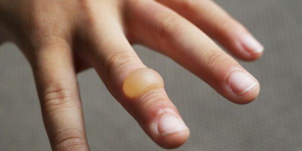 Queima de dedos – causas (lesões, doenças, drogas, deficiências)
