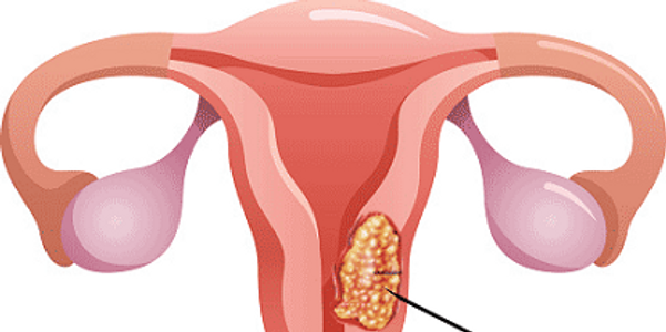 Tipos de câncer cervical, causas e fatores de risco