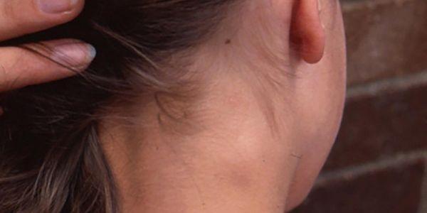 causas de gânglios linfáticos do pescoço inchados
