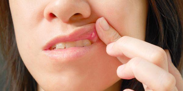 causas de úlceras na boca oral úlceras