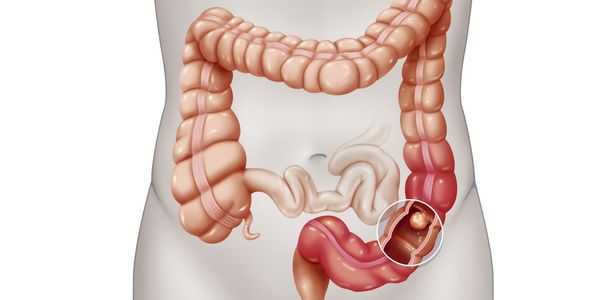 câncer de intestino delgado provoca sintomas de tratamento