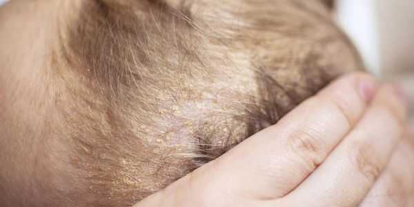 dermatite seborréica retratos tratamento rosto couro cabeludo recém-nascidos
