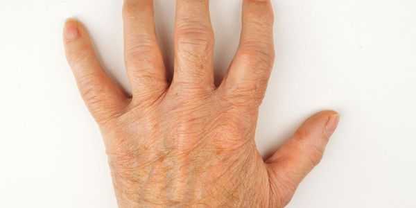 dor de junta na mão ossos e articulações causas e tratamento