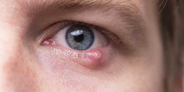 dor nos olhos causa outros sintomas e remédios