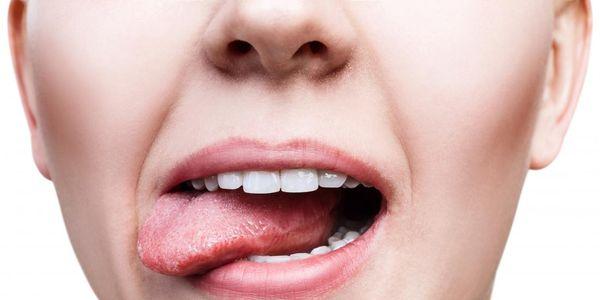 língua seca ressecada provoca doenças e remédios