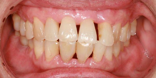 o que são diferenças e tratamento dos tipos de periodontite