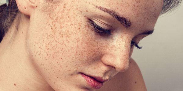 o que são sardas freckle vs lentigo manchas de fígado e moles
