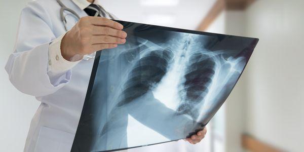 o que é asbestose asbesto inalação doença pulmonar