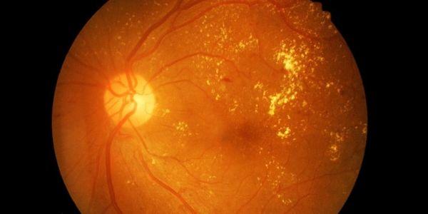 o que é diabetes retinopatia diabetes retina sintomas da doença