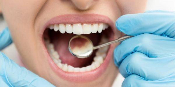 o que é um dente cavidade sintomas e processo de cárie dentária
