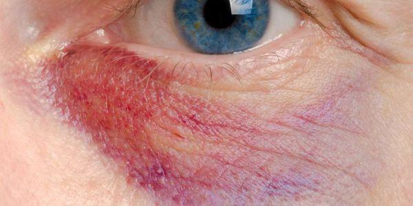 olhos sensíveis significado significa tratamento de sintomas