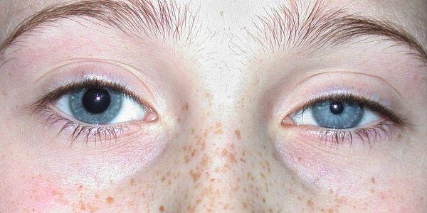 pupilas dilatadas aumentadas de causas oculares e outros sintomas