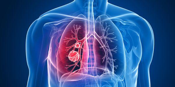 sinais de câncer de pulmão e fatos sobre tumores de pulmão