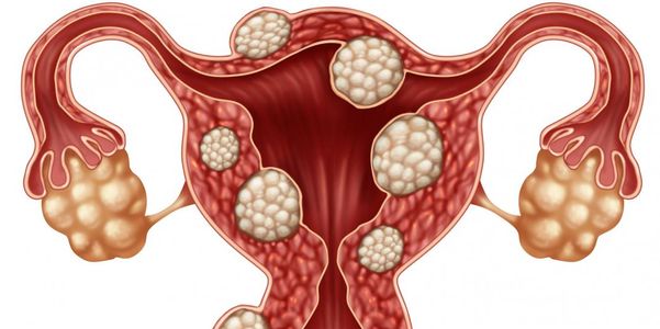 sinais de miomas no útero e risco de câncer