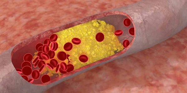 sinais de níveis elevados de colesterol no sangue
