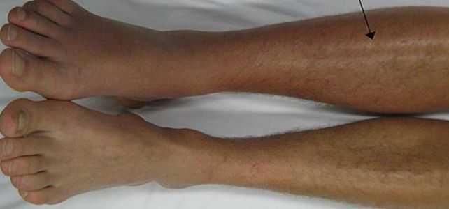 trombose venosa profunda perna veia coágulo dvt fotos sintomas