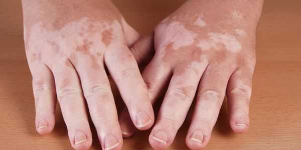 vitiligo doença de pele branca irregular faz sintomas fotos